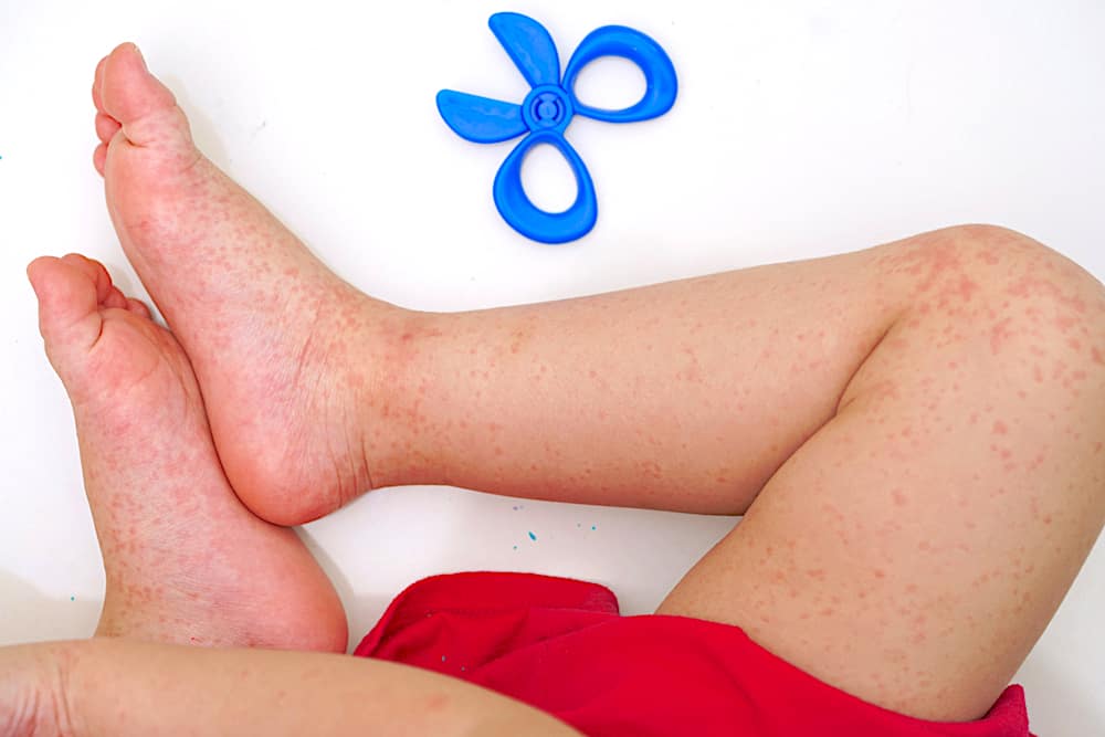 symptoms-and-treatment-of-kids-roseola