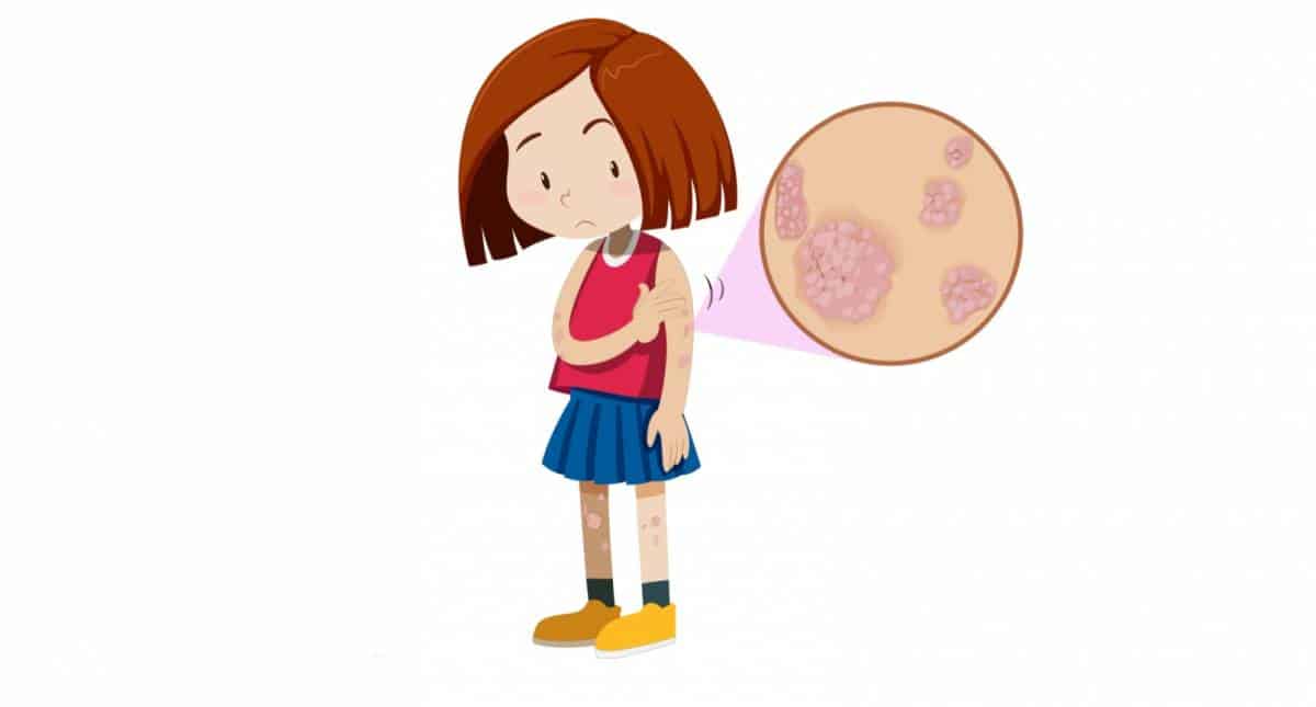 what-parents-should-do-when-kids-have-psoriasis