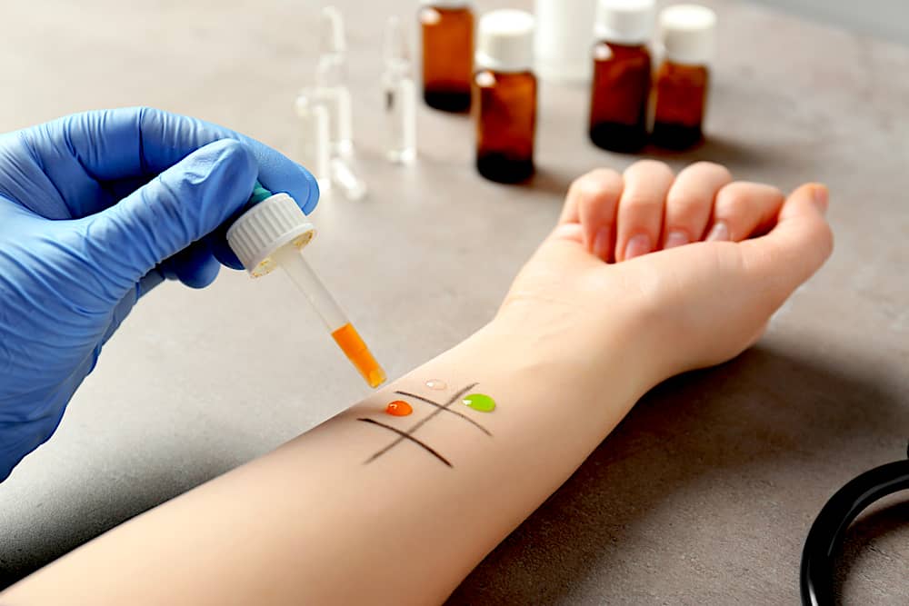 skin-test-of-allergen