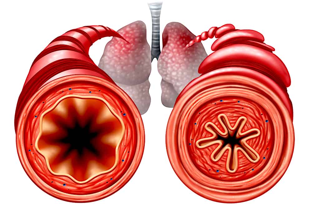 5-surprising-asthma-triggers