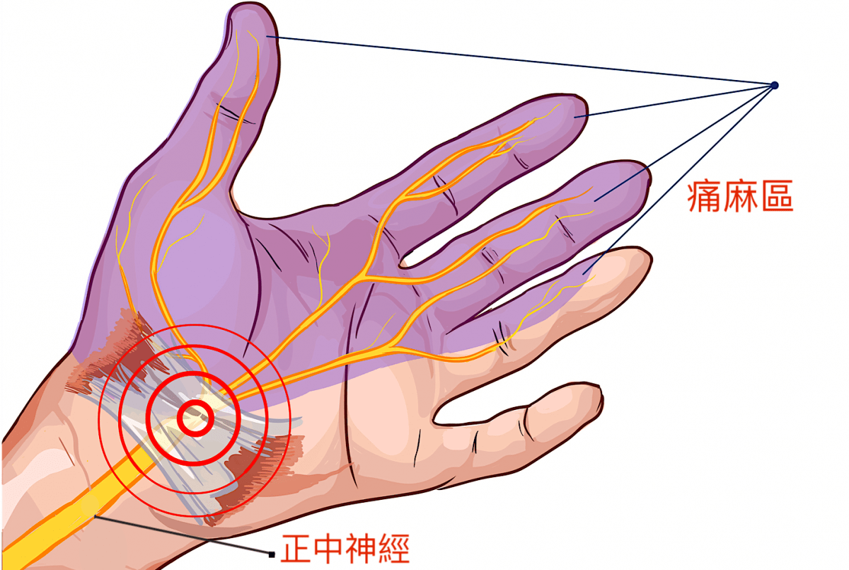 what-is-the-carpal-tunnel-syndrome