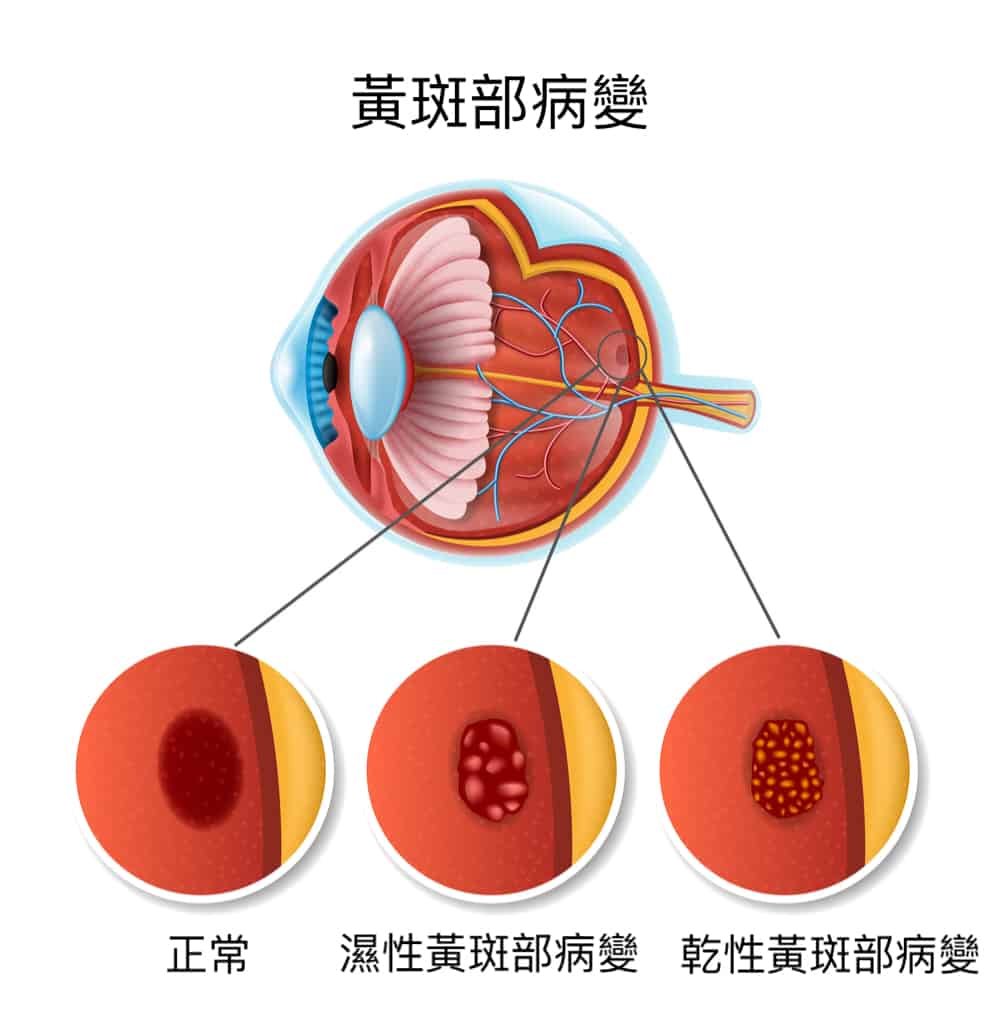 macular-degeneration