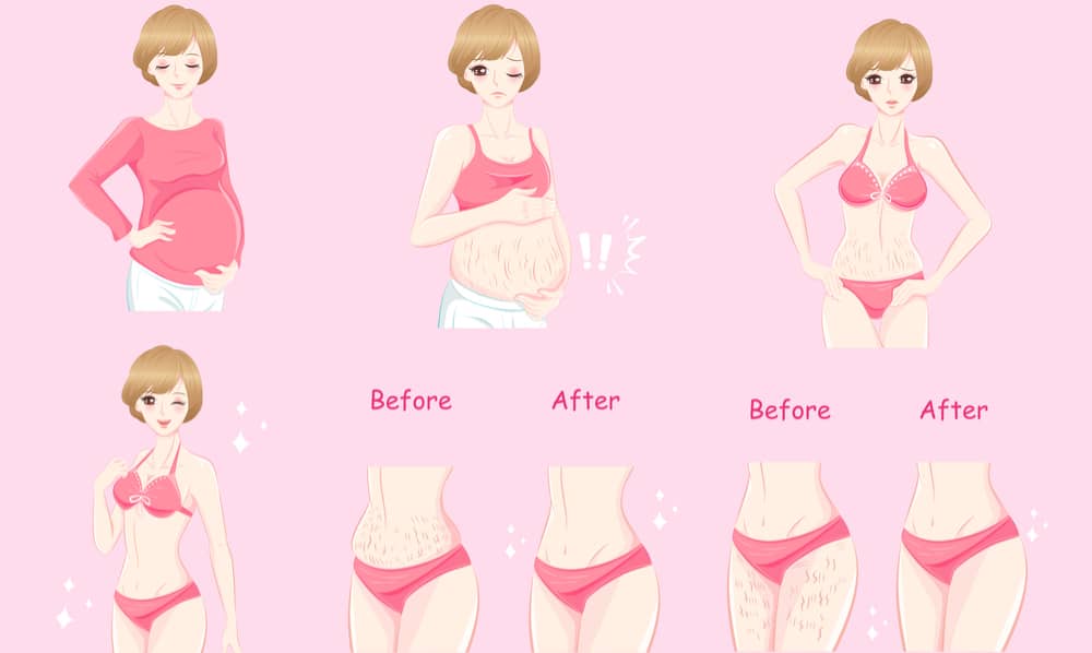 prevent-stretch-mark-in-pregnancy