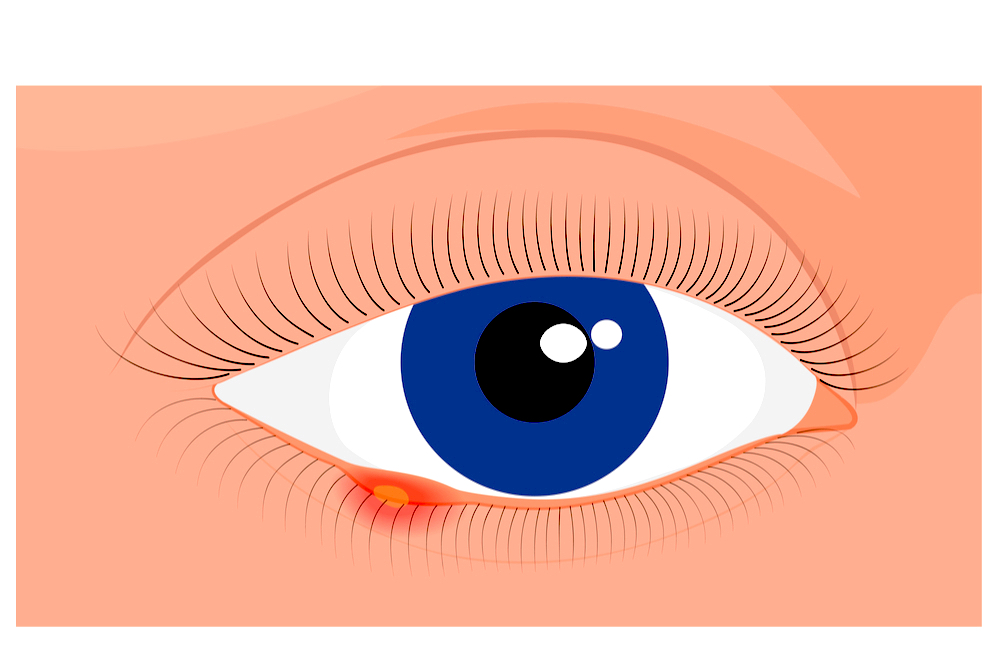 causes-and-symptoms-of-stye