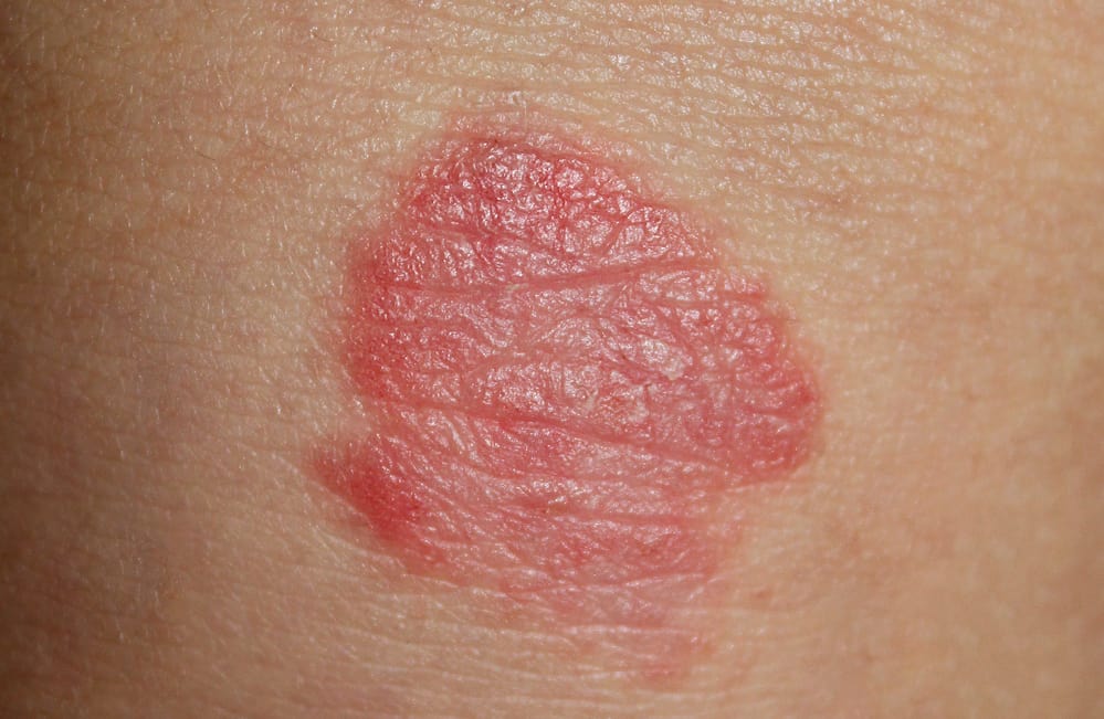 symptoms-and-treatment-of-kids-psoriasis