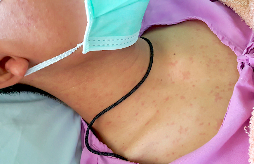 symptoms-treatments-measles