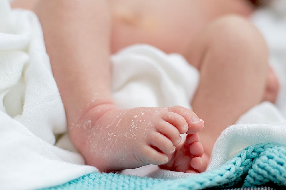 know-the-cause-and-treatment-of-child-dry-skin