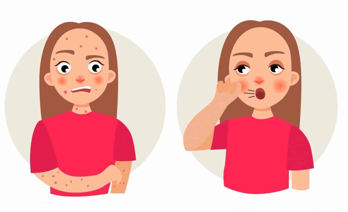 atopic-eczema-food-allergy