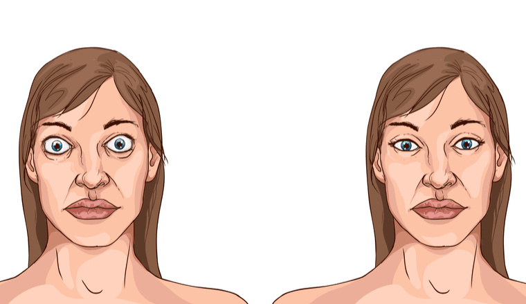 causes-of-thyroid-eye-disease