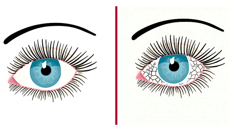causes-of-eye-infections