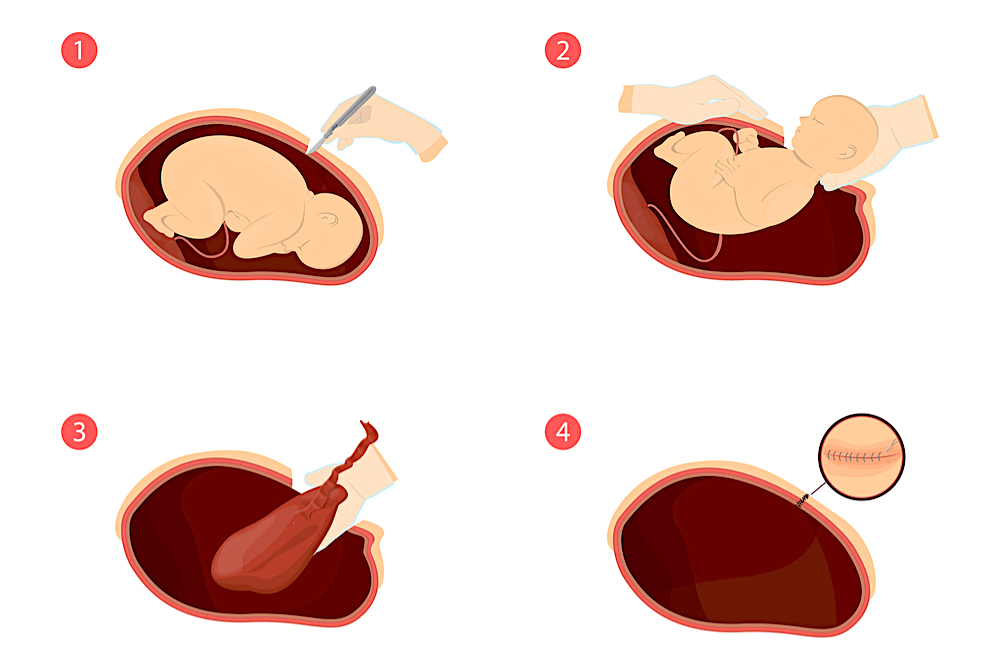 c-section-compares-with-vaginal-birth