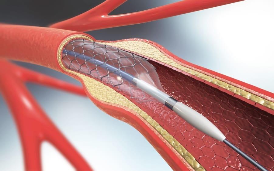 coronary-artery-bypass-surgery