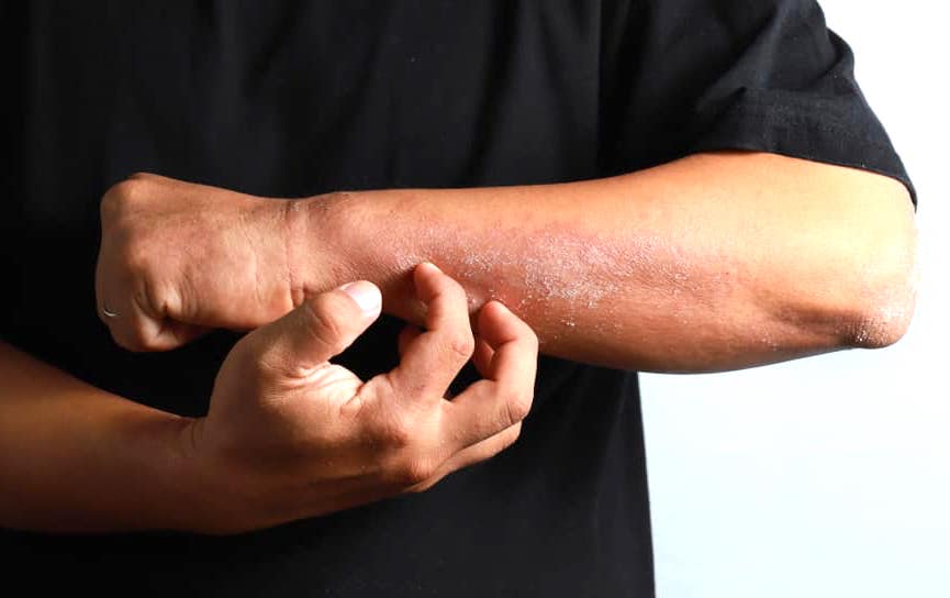 latex-allergy-prevention-guide