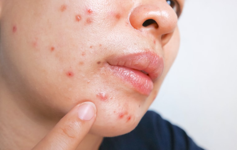 what-is-acne