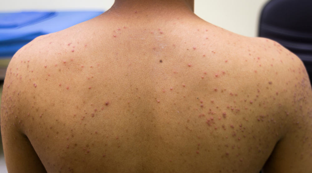 folliculitis