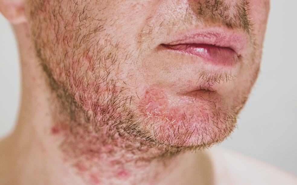 folliculitis-what-you-should-know