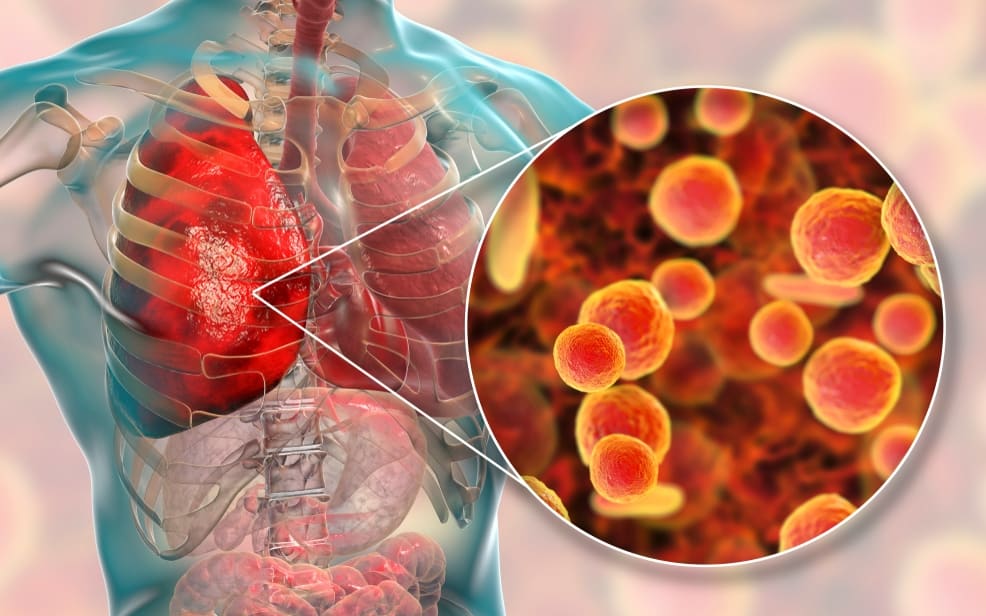 walking-pneumonia-causes-and-symptoms