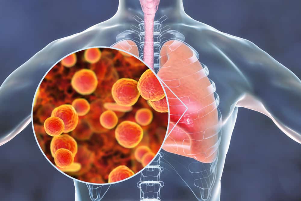 mycoplasma-pneumonia