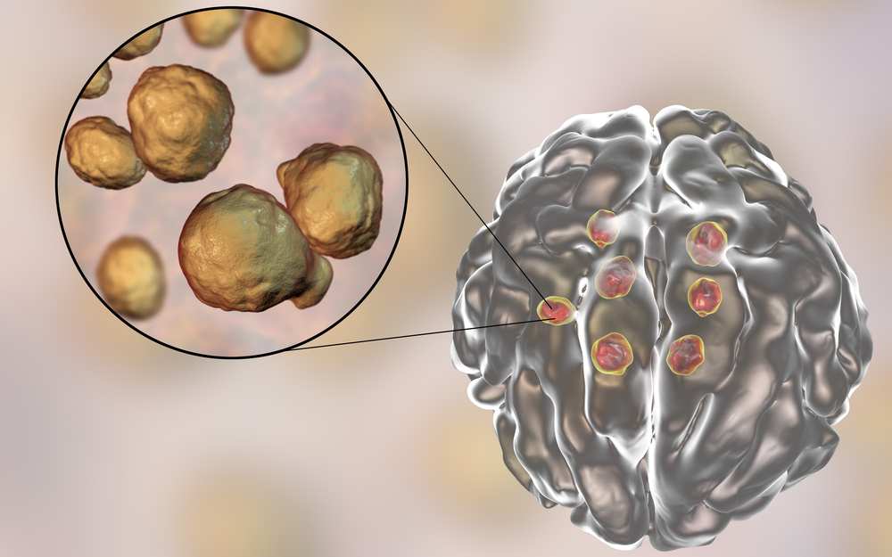 cryptococcosis