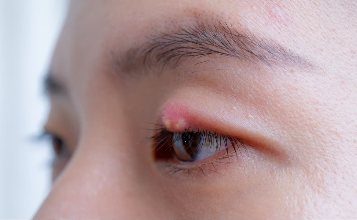 risk-factors-of-styes-and-ways-to-prevent-them