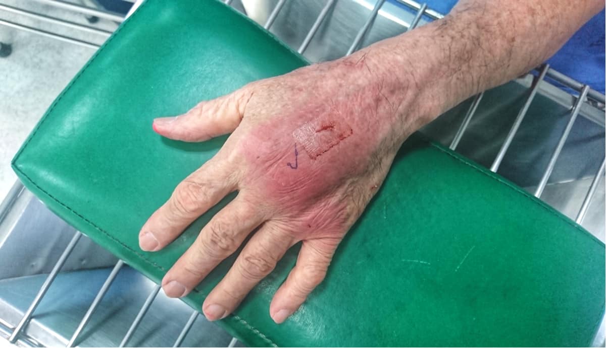 the-causes-and-symptoms-of-cellulitis