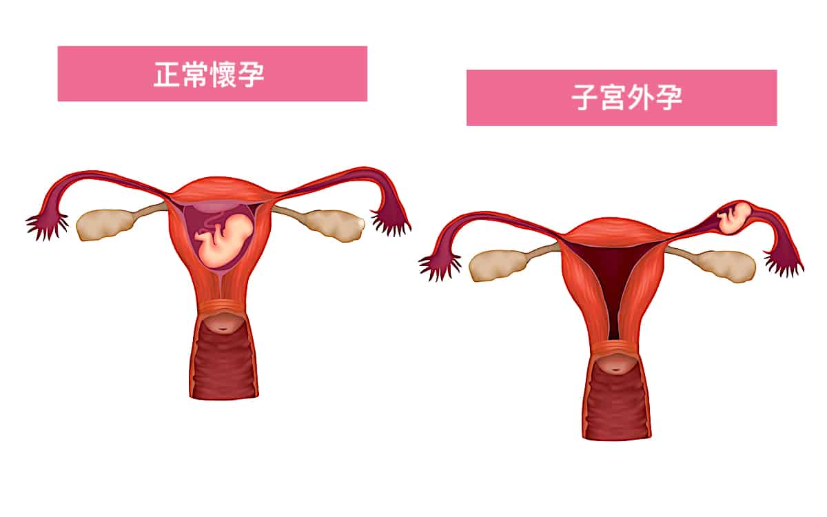 ectopic-pregnancy-symptoms