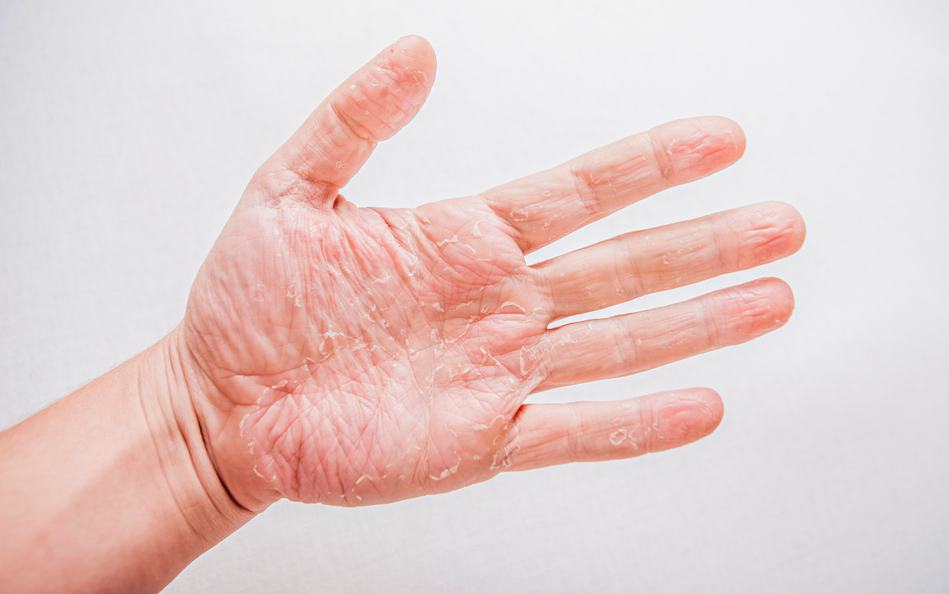 4-home-remedies-of-hand-eczema