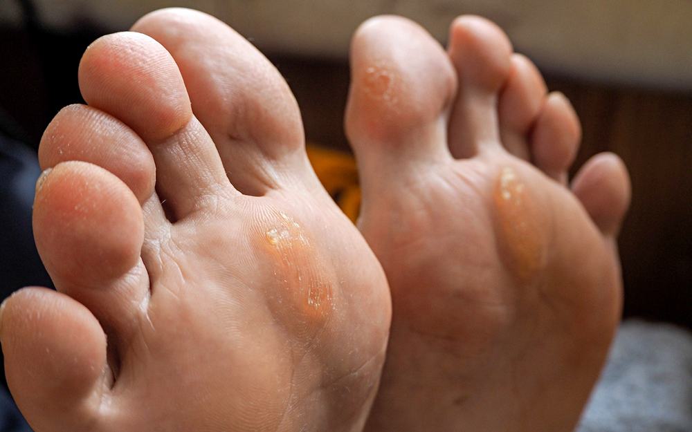 corn-callus-symptoms-and-treatment
