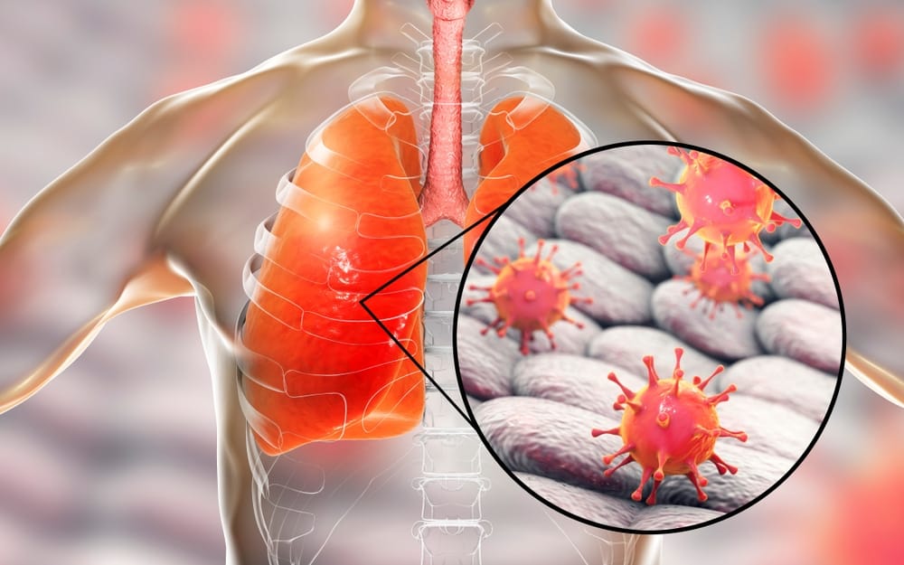 viral-pneumonia