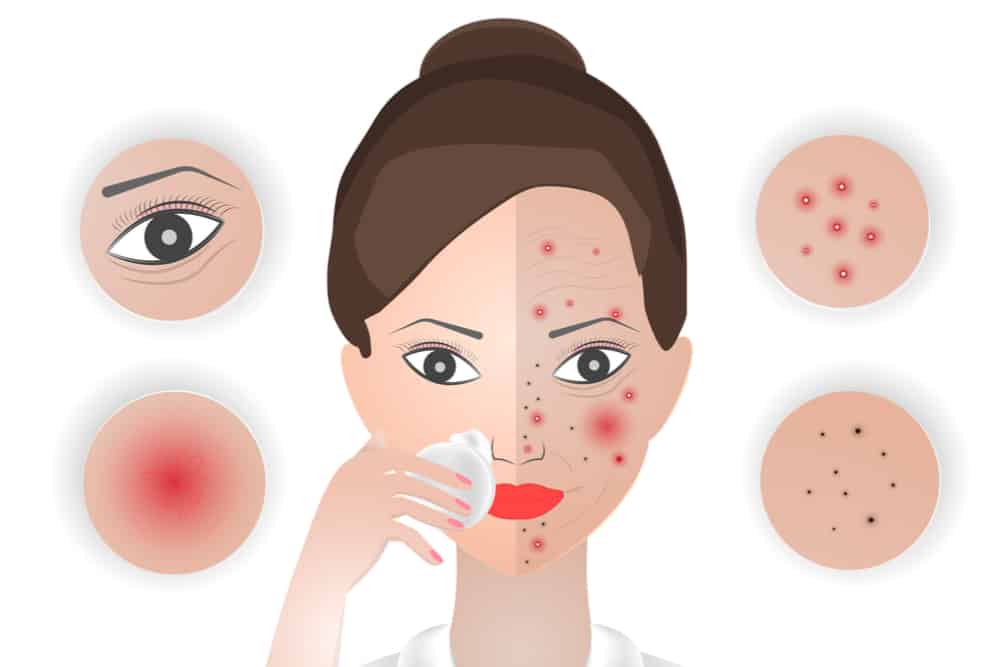 anti-acne-tips