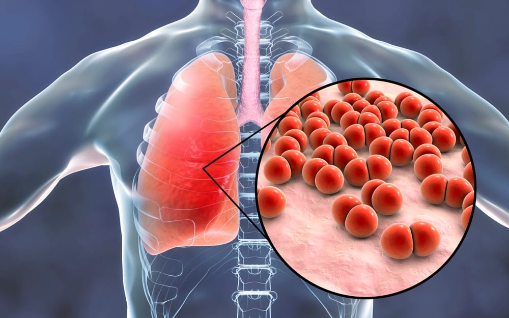 pneumonia