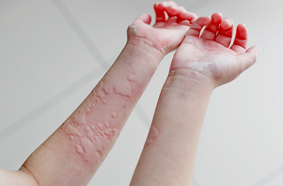 causes-symptoms-and-treatments-of-urticaria