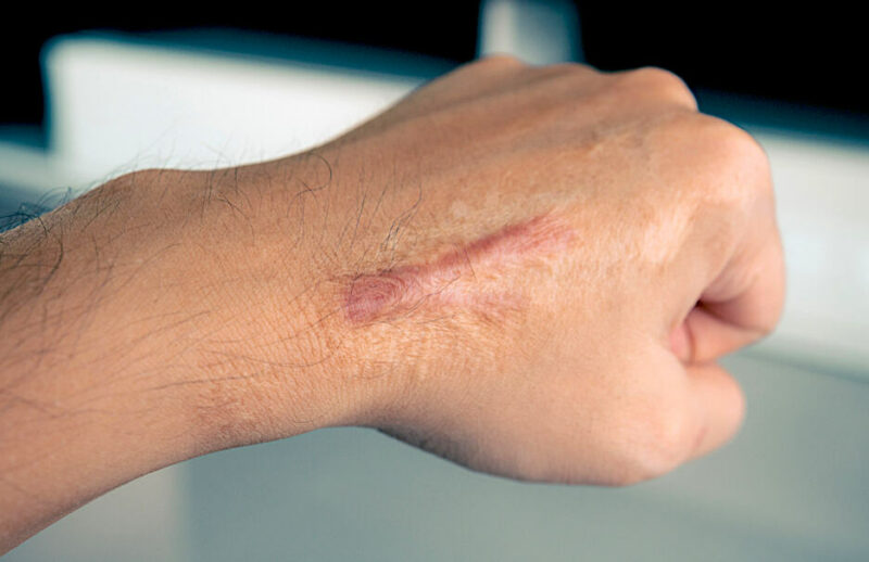 keloid-the-symptom-that-ruin-your-beauty