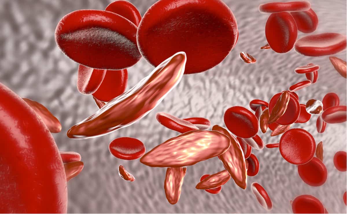 sickle-cell-anemia
