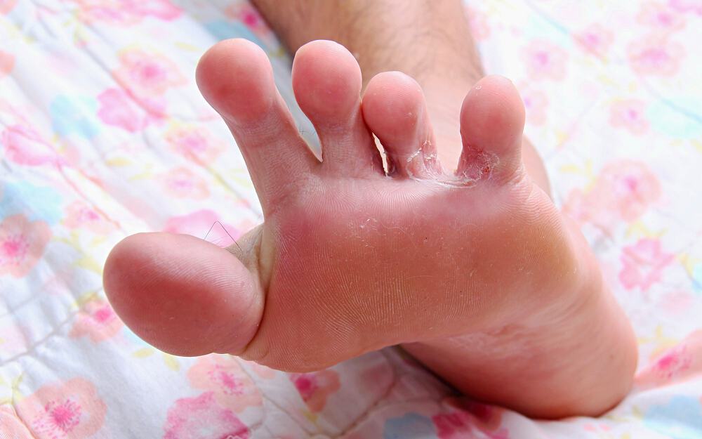 2-hygiene-care-to-prevent-athletes-foot