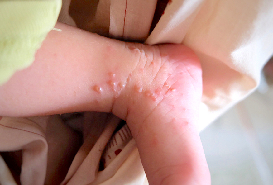 tips-to-prevent-dyshidrosis-eczema