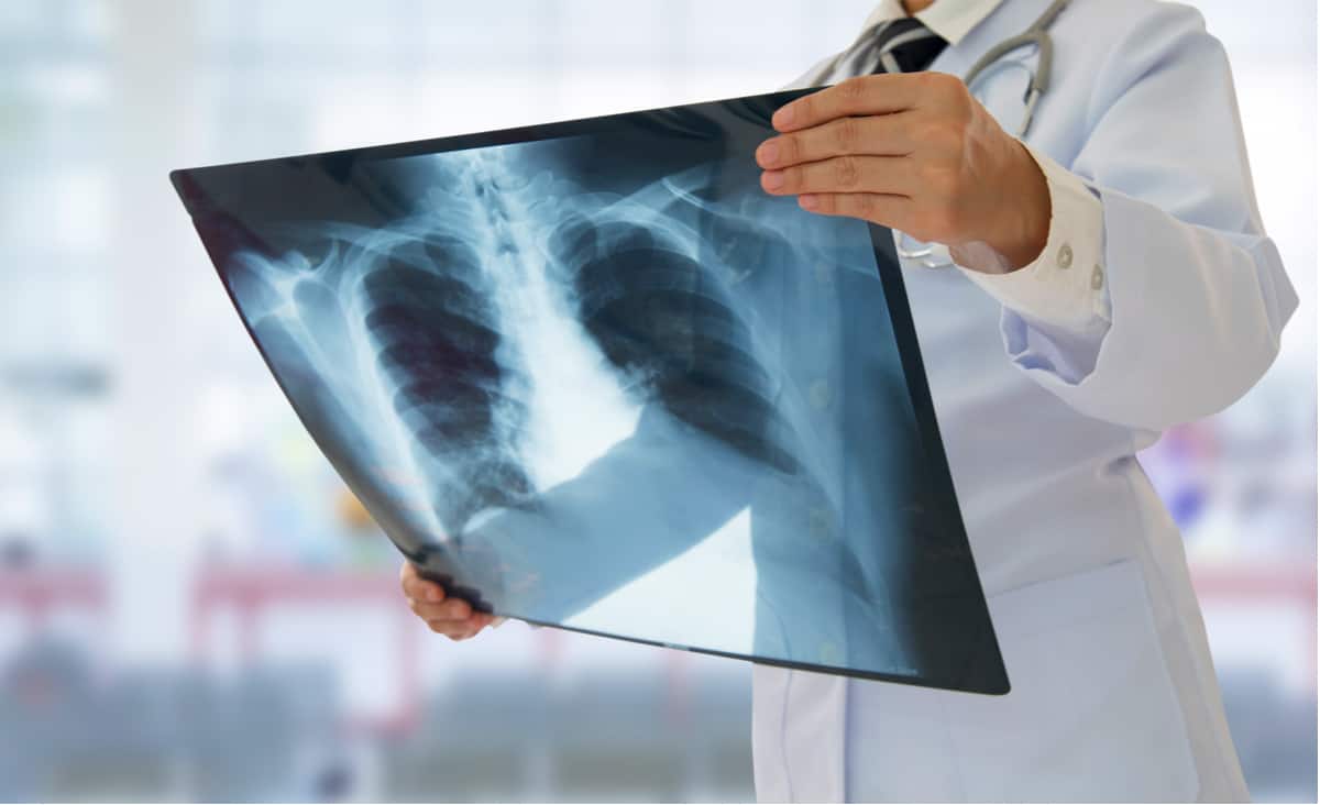tuberculosis
