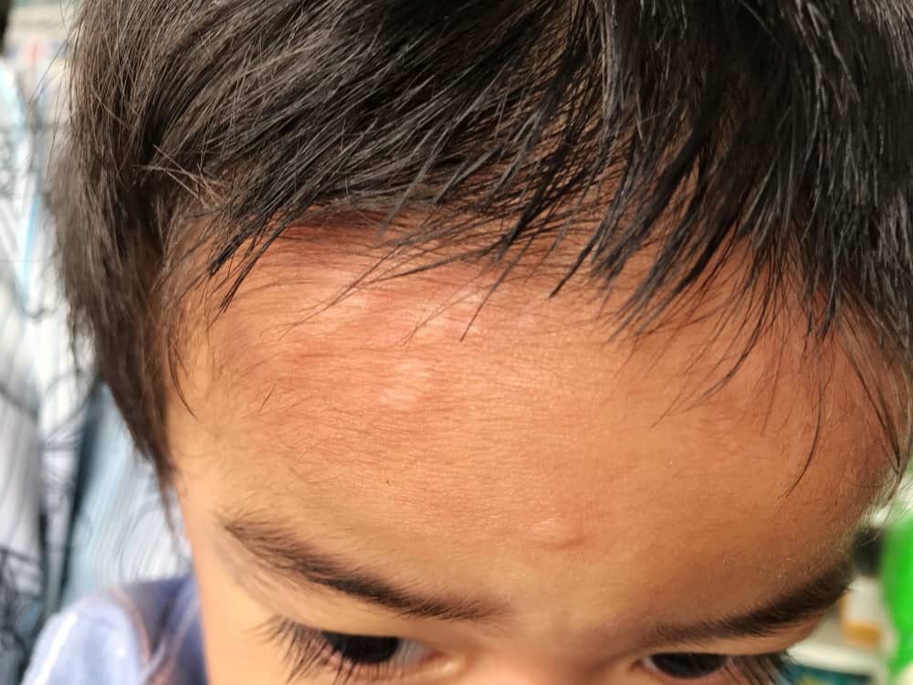 angioedema
