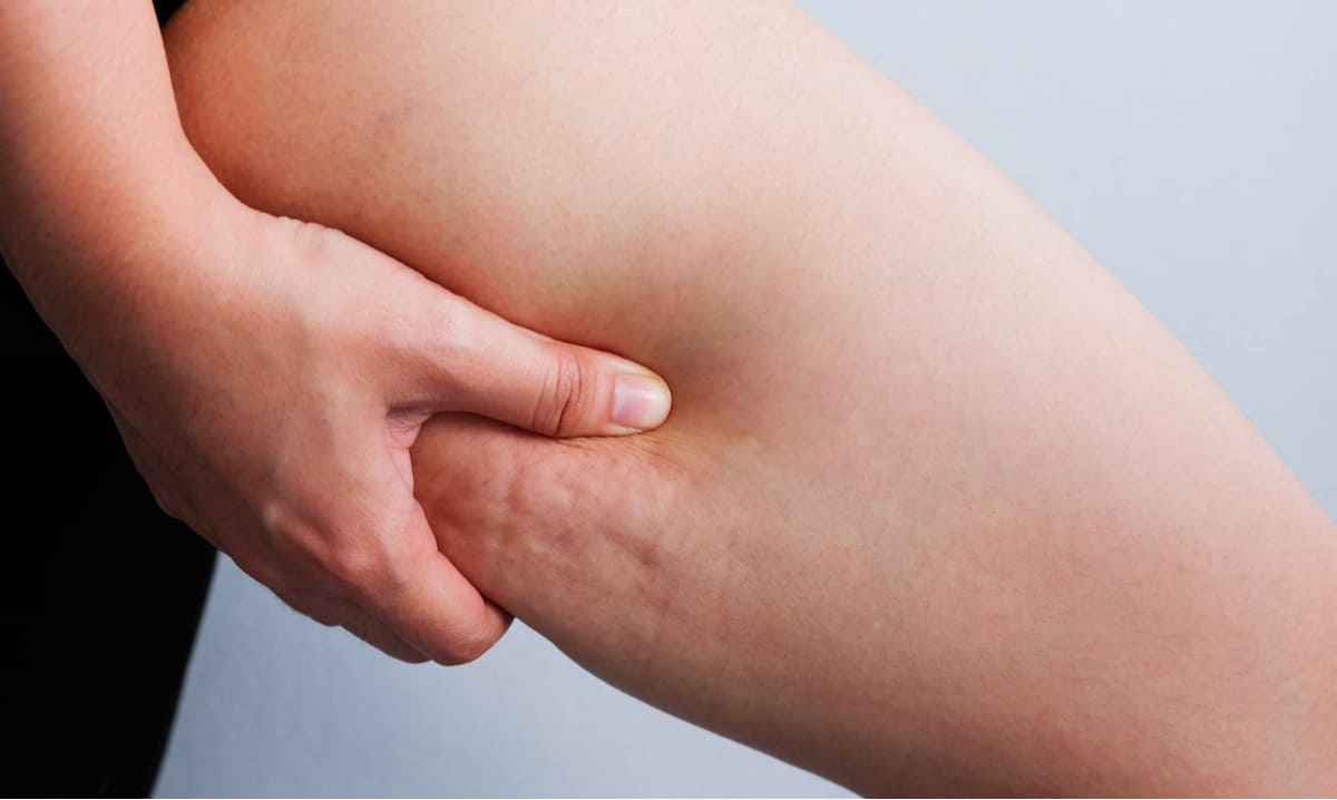 all-you-need-to-know-about-cellulite