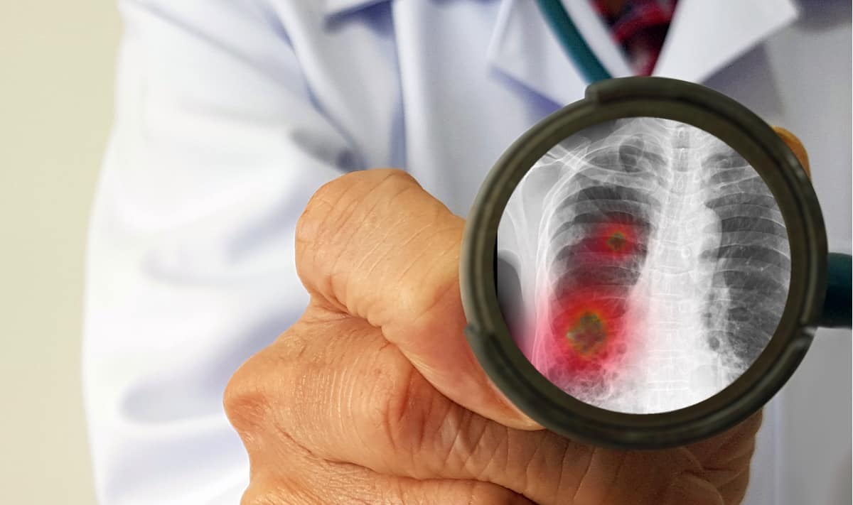 atypical-pneumonia