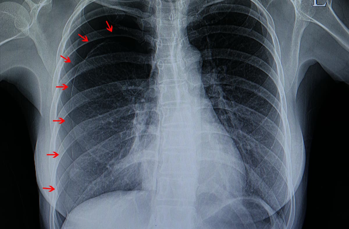 pneumothorax