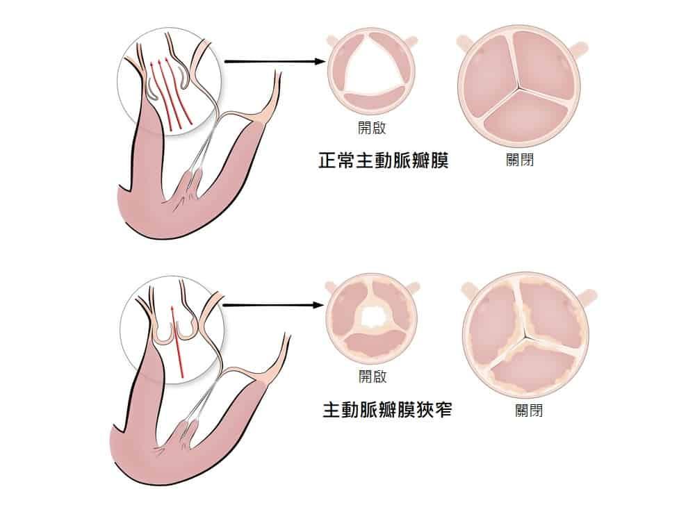 aortic-valve-stenosis-symptoms-and-treatment-2