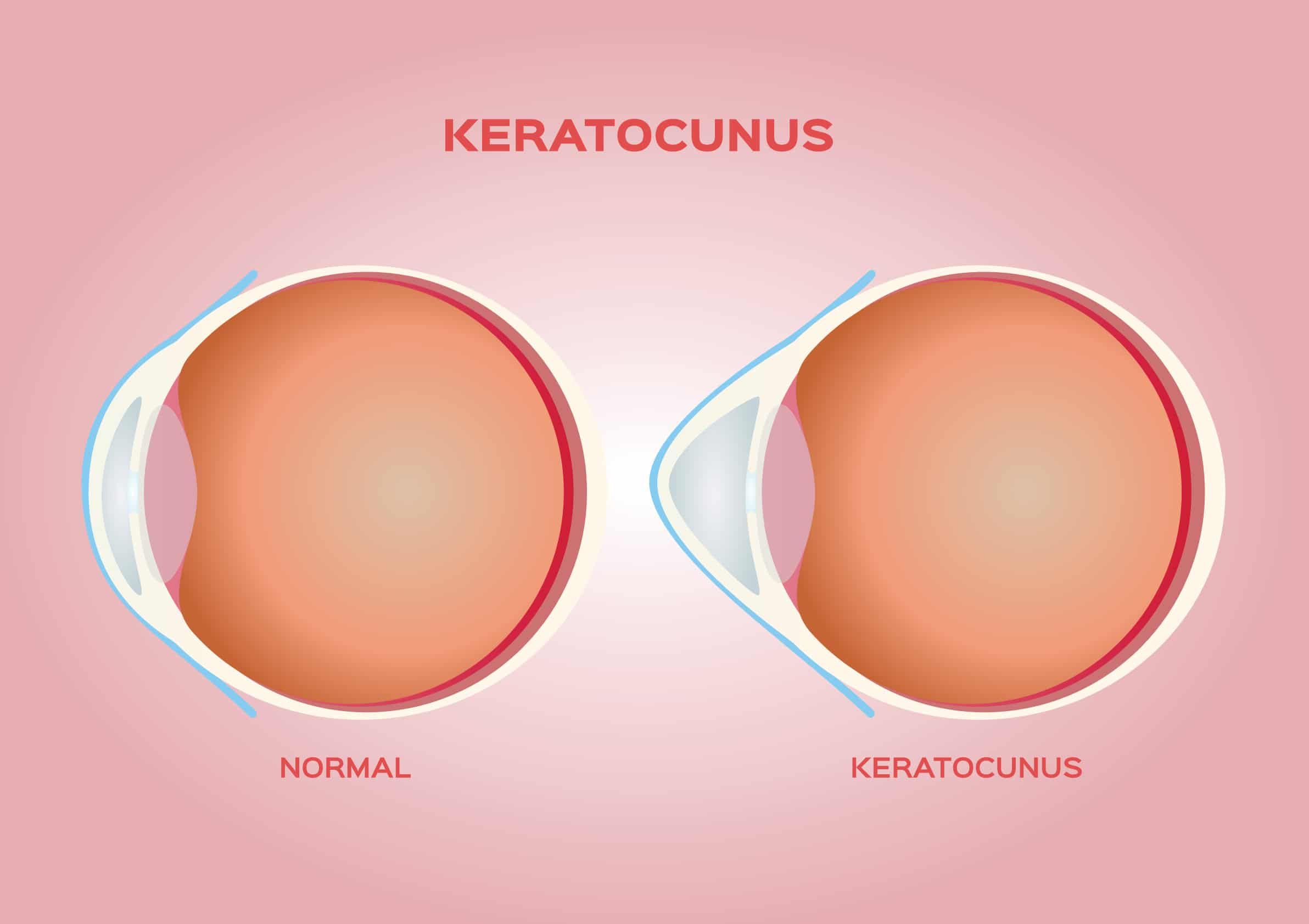 what-is-keratoconus