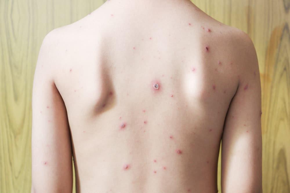 chickenpox-adults-infection-twice