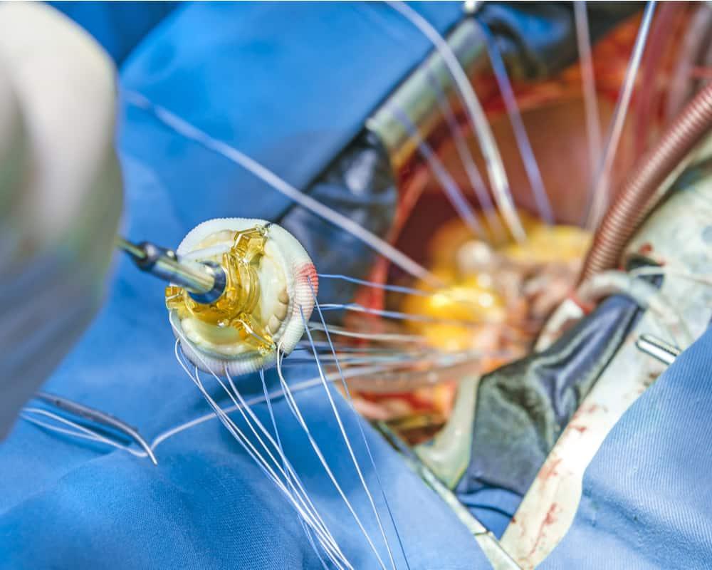 heart-valve-replacement-surgery