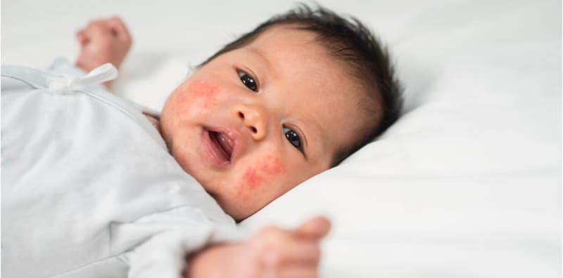 seborrheic-dermatitis-in-infants-reasons-and-treatment