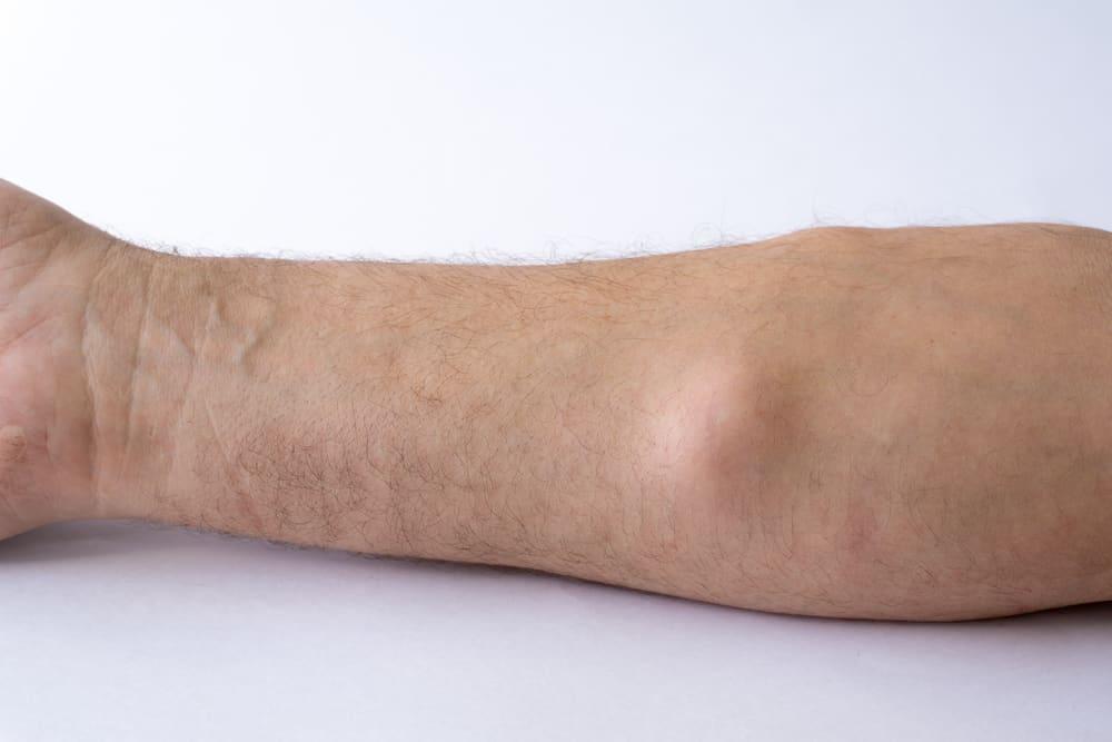 what-is-lipoma-and-all-you-need-to-know-about-lipoma