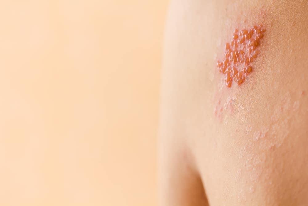 the-cause-of-varicella-zoster-virus