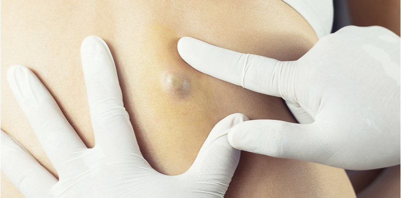 what-is-epidermoid-cyst