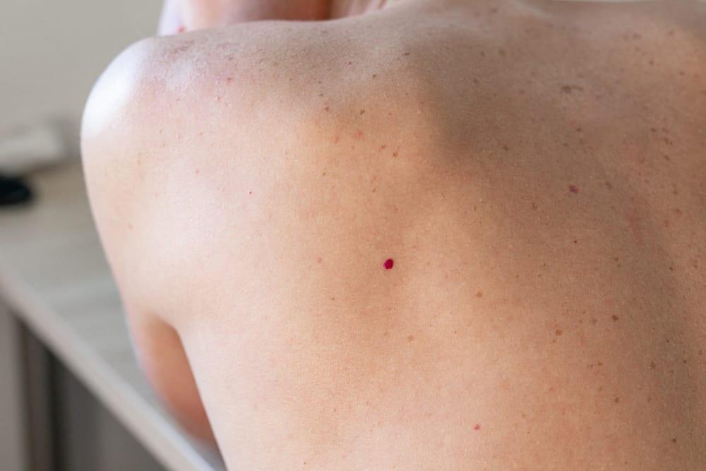 what-is-cherry-angioma